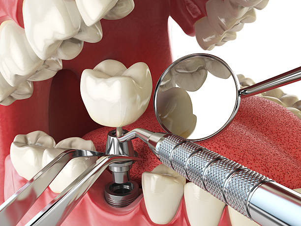 Best Emergency Dental Extractions in Spring Valley, IL